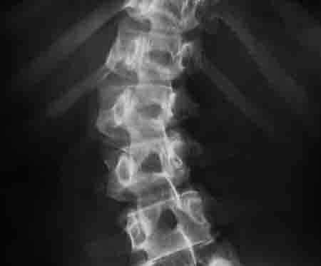 Efeito da Escoliose na coluna vertebral (Foto: ilustrativa)