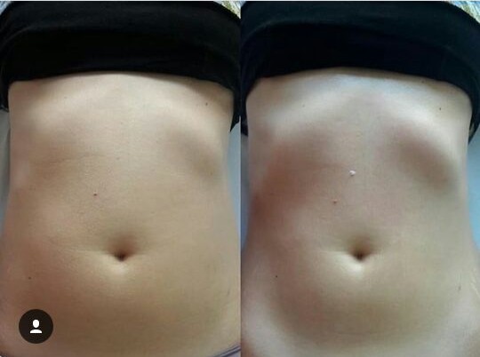 Antes e depois do tratamento