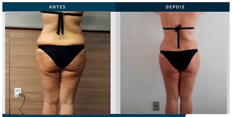 Antes / depois